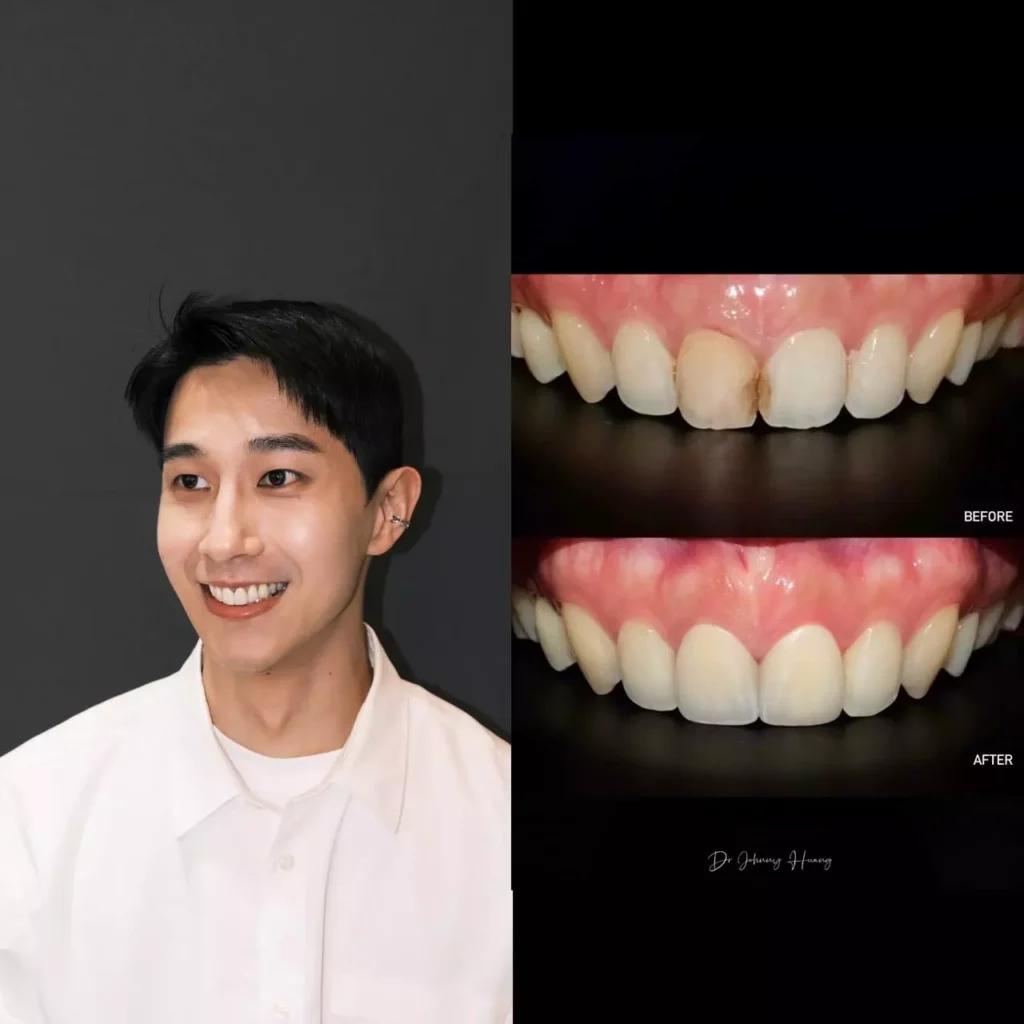 牙貼